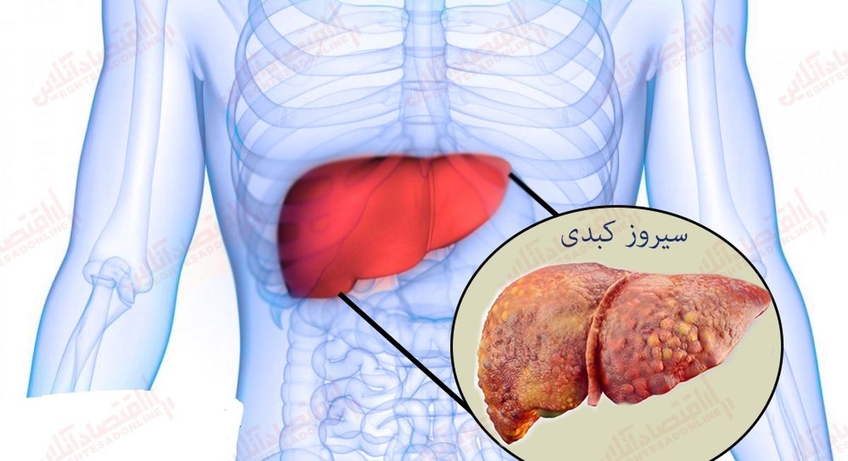 سیروز کبدی