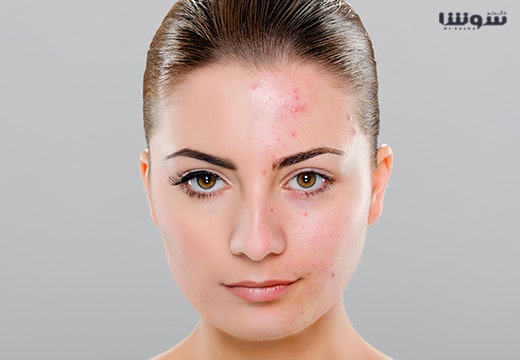 از بین بردن جوش