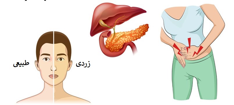 سرطان پانکراس