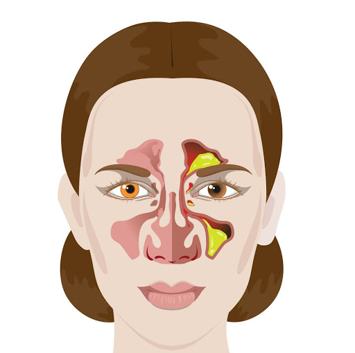 سینوزیت