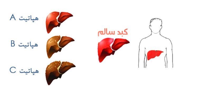 هپاتیت