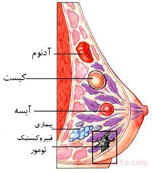 کیست سینه